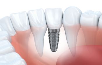 Model Of Dental Implant